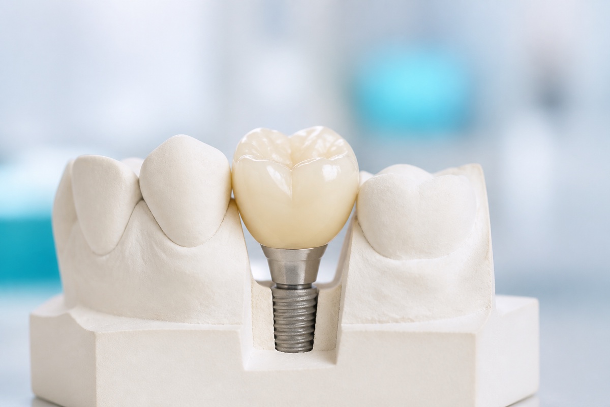 Cement-retained implant crown and abutment without an access channel